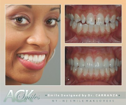 Smile makeovers