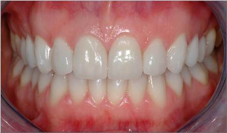 Veneers after