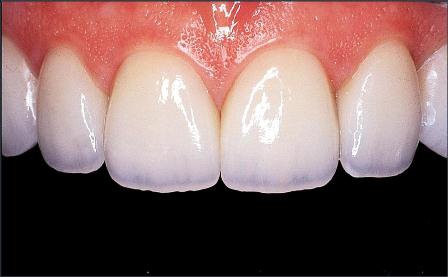 Veneers closing spaces