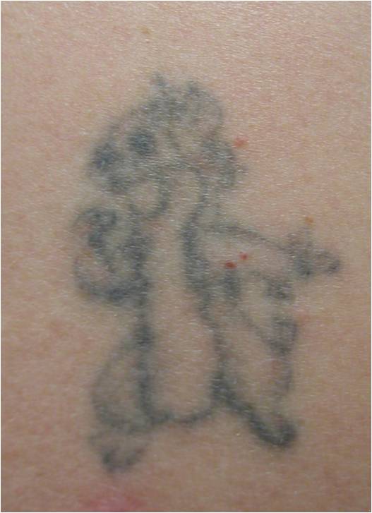 Tattoo Before Treatment