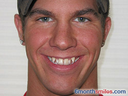 Six Month Smiles Before & After