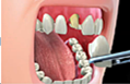 Sisters, Oregon Dentist Procedure Videso