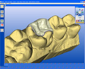 CEREC 3D