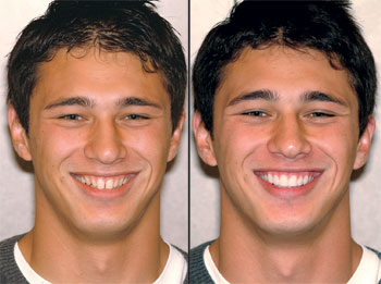 Invisalign San Diego Before & Afters