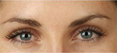 lip augmentation