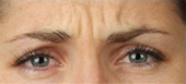 botox cosmetic injections