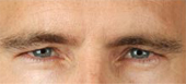 botox wrinkle removal
