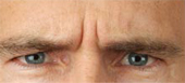 botox wrinkle removal