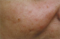 Cutera CoolGlide Vein Therapy