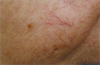 Cutera CoolGlide Vein Therapy