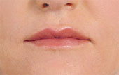 facial filler injection