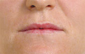 juvederm