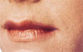 Juvederm