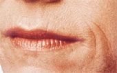 lip augmentation