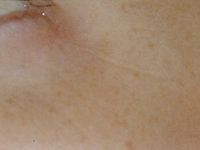 Laser Genesis Skin Therapy