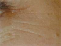 Laser Genesis Skin Therapy