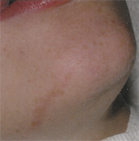 laser skin surgery