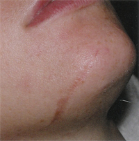 laser skin resurfacing