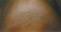 laser skin care