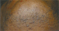 Laser Hair Removal