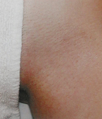 Cutera CoolGlide Laser Hair Removal