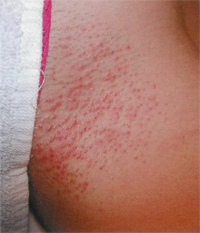 Cutera CoolGlide Laser