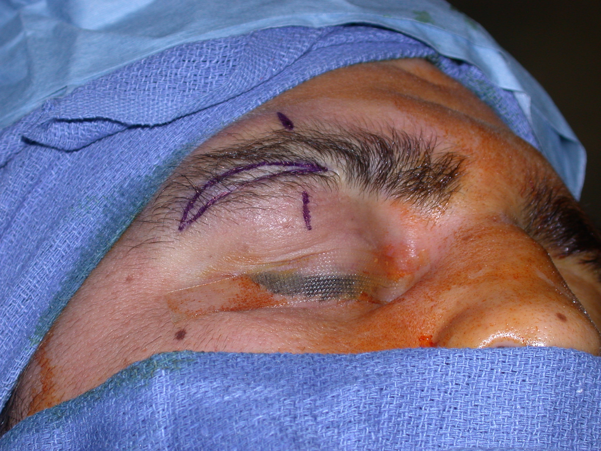 Facial Scar Surgery