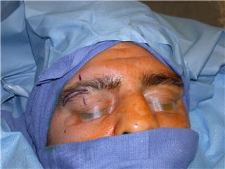Nick Diaz Facial Surgery
