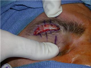 UFC Facial Surgery