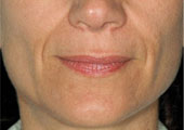 lip augmentation