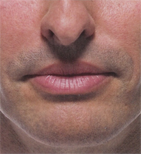 radiesse wrinkle remover