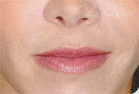 facial filler injection