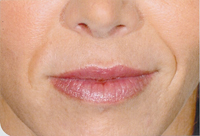 Restylane