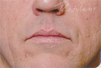 Restylane