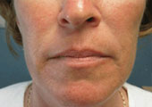 Sculptra