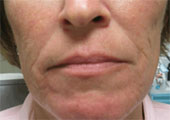 Sculptra injectable