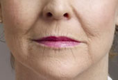 tca glycolic skin peel