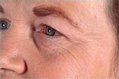 skin resurfacing
