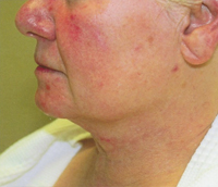 laser skin resurfacing