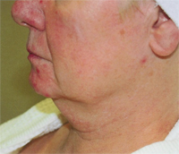 titan skin tightening