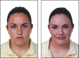 youth acne