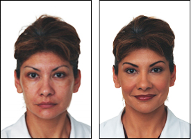 melasma/ hyperpigmentation