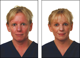 Rosacea