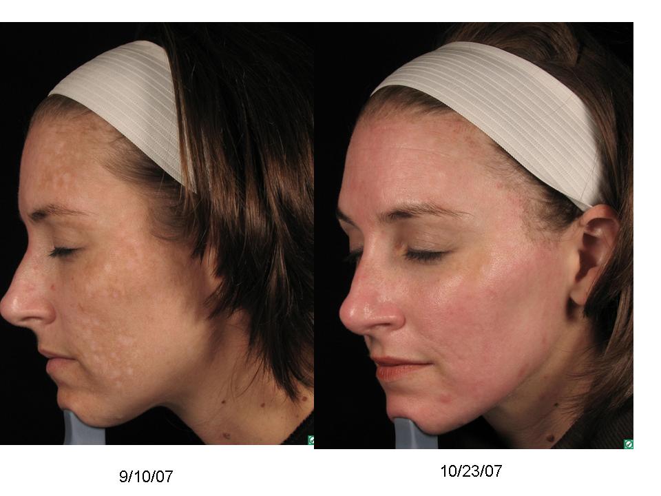 Mixto Before & After SideView