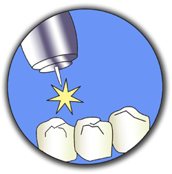 introduction to laser dentistry