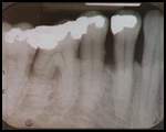 Dental Film of Advanced Bone Loss