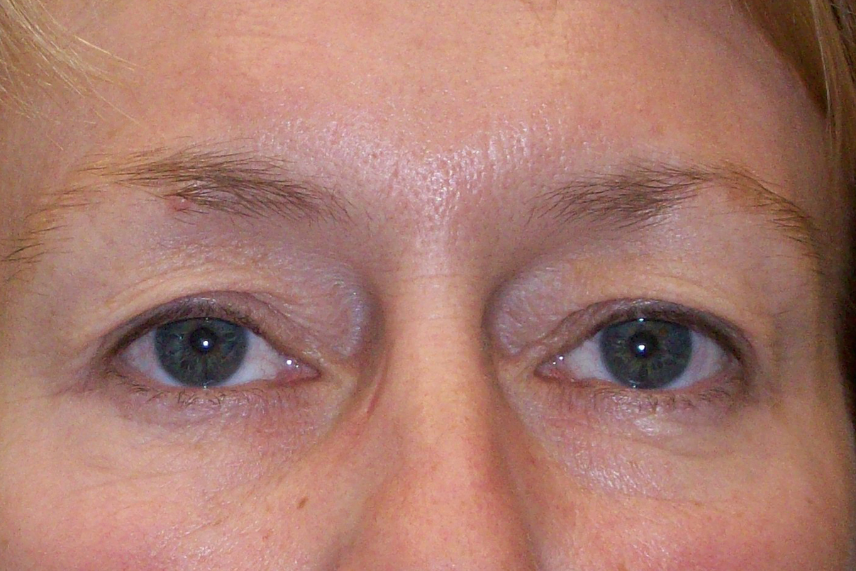 before Blepharoplasty