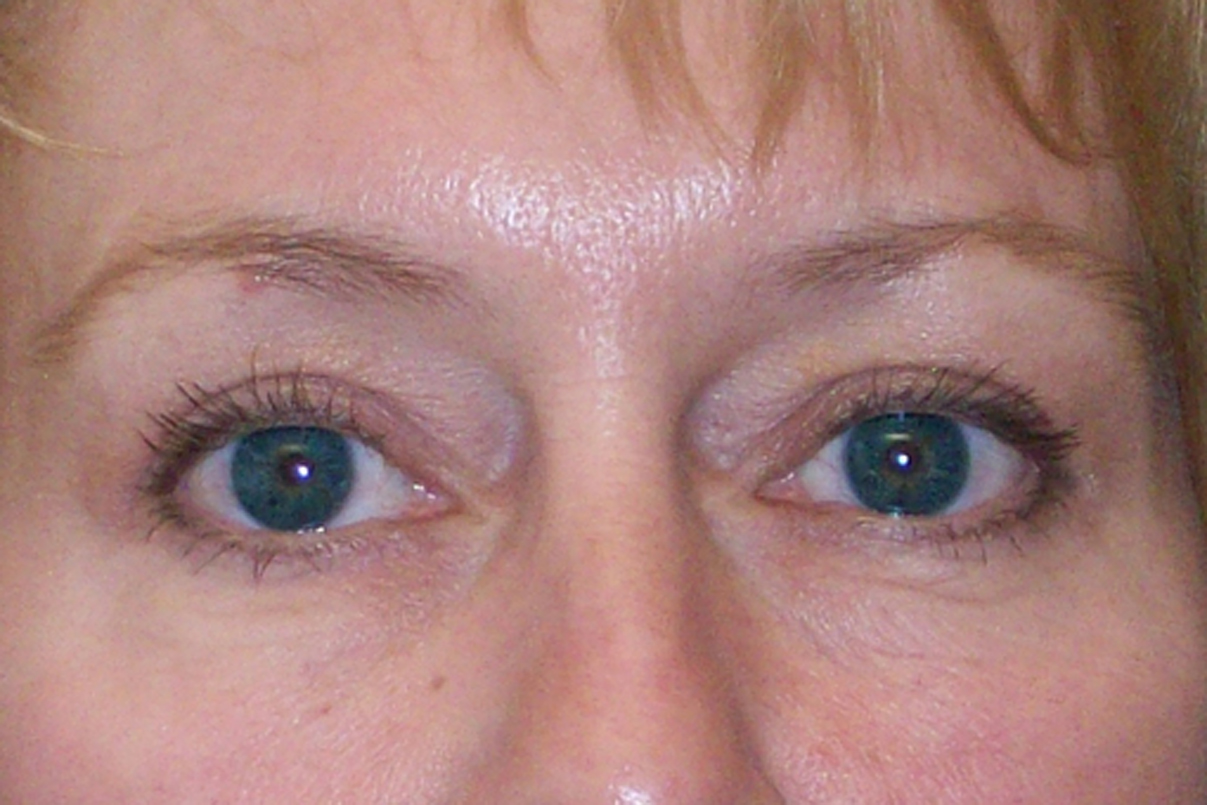 After Blepharoplasty
