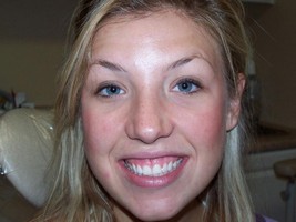 Gummy Smile