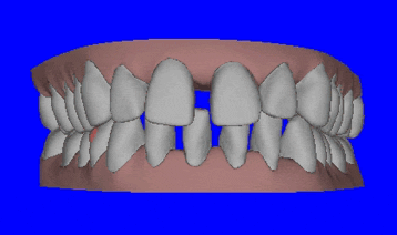 Houston Invisalign